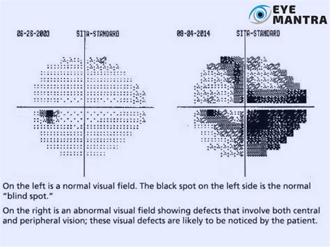 eye field of vision test