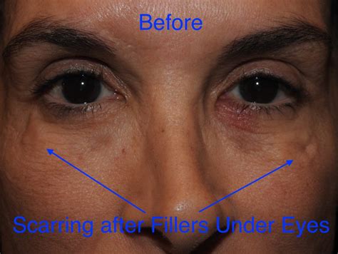 Eye Filler Problems