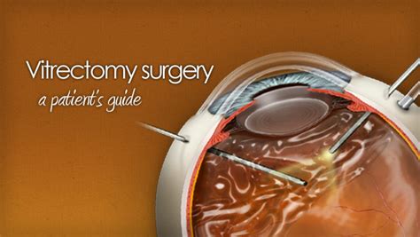 eye floater surgery recovery time
