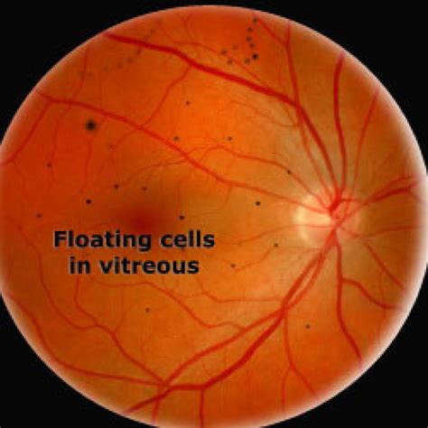 eye floater vitreous detachment