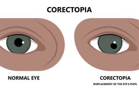 Eye Iris Not Centered