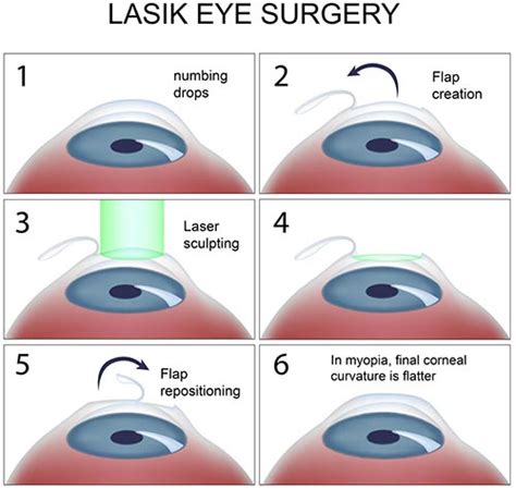 eye laser surgery price nyc