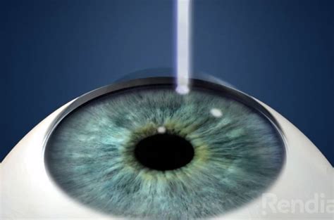 eye lasik austin tx