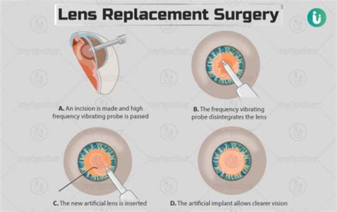Eye Lens Replacement Problems