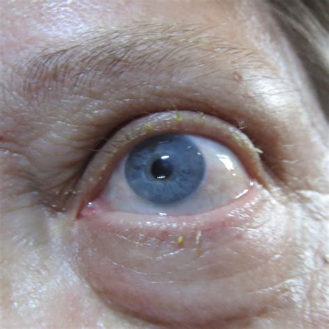 eye pain 2 months after cataract surgery