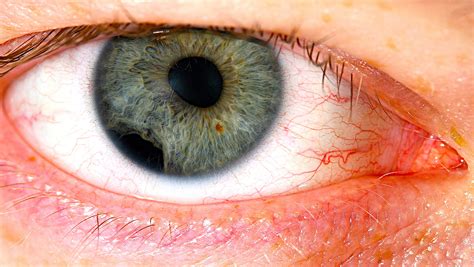 Eye Patch Damage Eyes