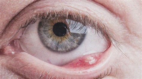 eye problems stye inside eyelid