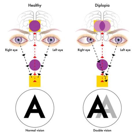 eye specialist for double vision
