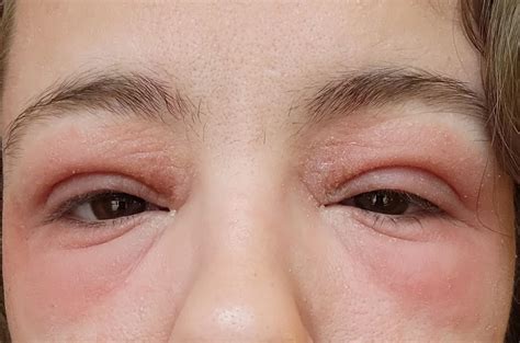 Eye Swelling Reddit