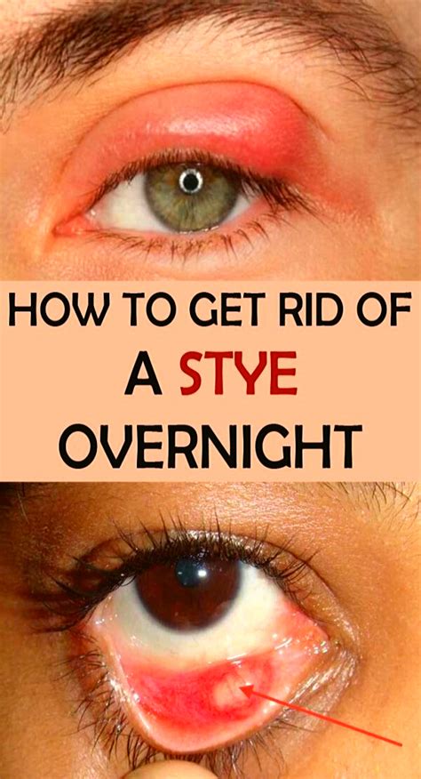 Eye Swollen Stye Treatment