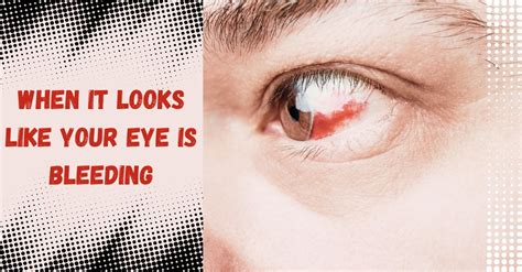 Understanding Eye Vein Bleeding: Causes, Symptoms, and Treatment Options
