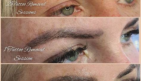 Eyebrow Tattoo Removal Edmonton Before And After Best Ideas For Men &