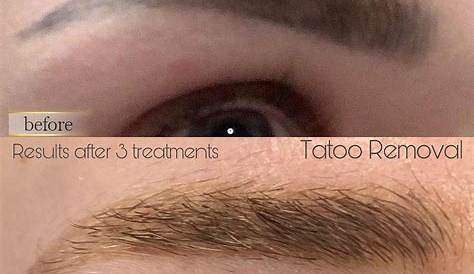 Eyebrow Tattoo Removal Montreal Eisen Abdeckung Fernsehen Laser Körper Idol Postbote