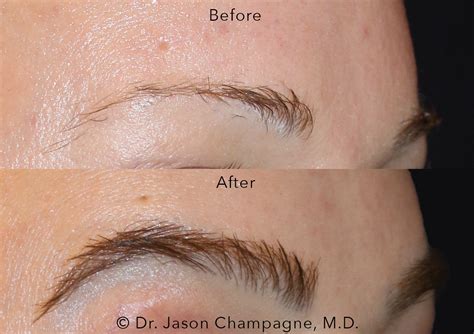 Dallas Eyebrow Hair Restoration Before and After Photos Plano Plastic