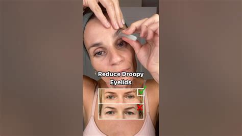 Eyelid Cupping Benefits