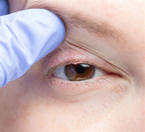 What Causes an Eyelid with Bump and How to Get Rid of It Safely