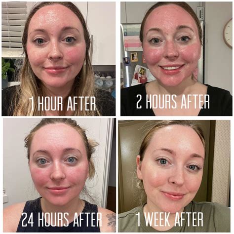 Face After Co2 Laser