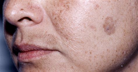 Reveal the Secret to Fading Face Age Spots Naturally