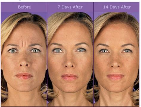 Face Aging Botox