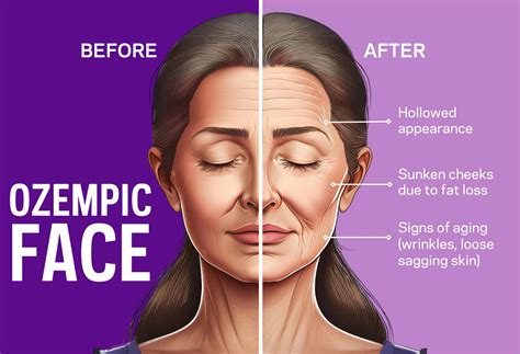 Face Aging With Ozempic