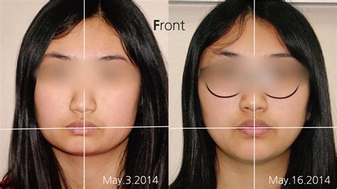 face asymmetry surgery