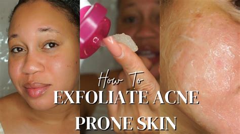 Face Exfoliate Acne