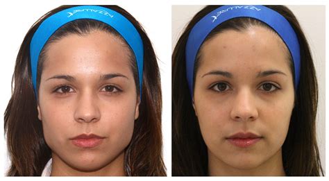 face slimming facial