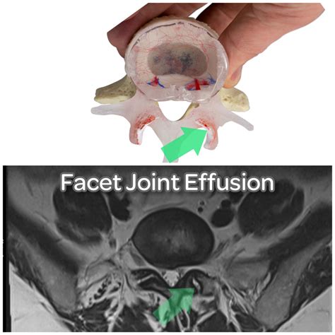 Facet Joint Effusion Definition