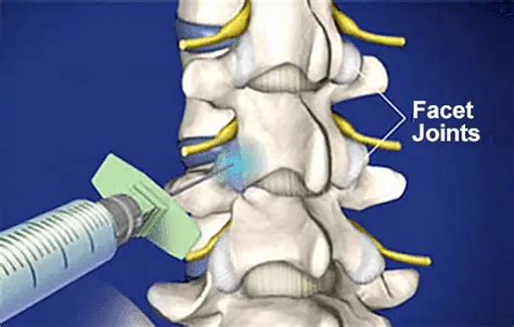 Facet Joint Injection Video