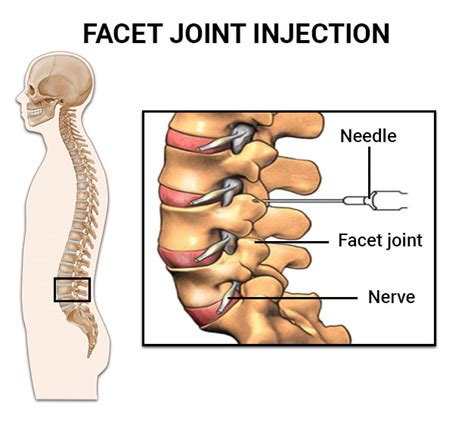 Relieve Back Pain with Facet Joint Injections: What You Need to Know