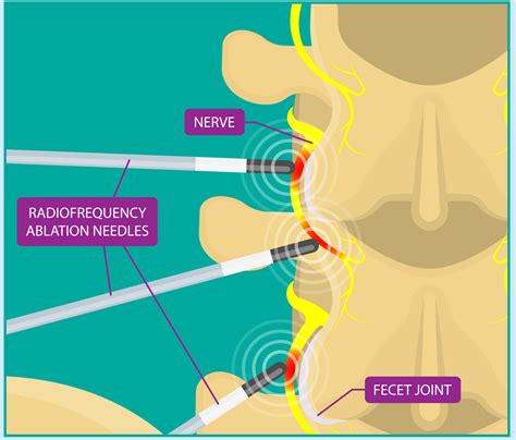 Facet Joint Radiofrequency Ablation
