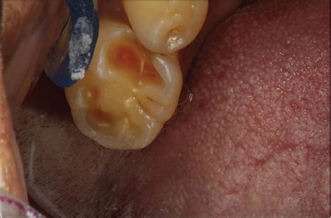 Facet Teeth Definition