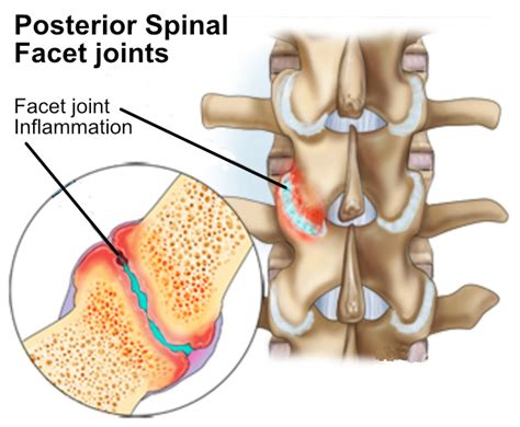 Facets Disease Lumbar