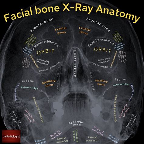 Facial Bones On Ct