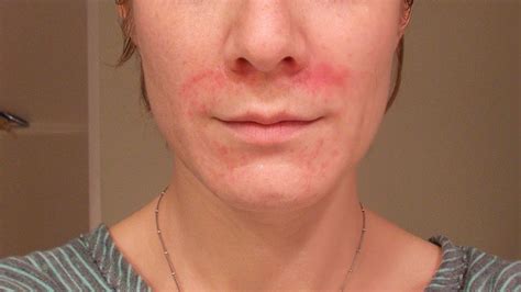 Facial Eczema Uk