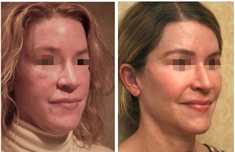 Facial Fat Grafting Problems