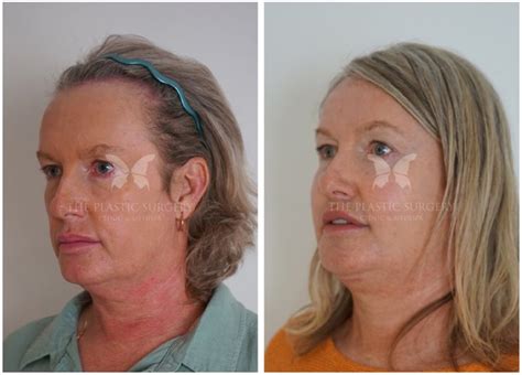 Facial Feminisation Surgery: Transforming Lives with Precision Care