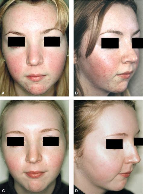 Facial Flushing After Gallbladder Surgery