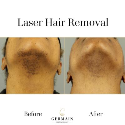 Facial Hair Growing Back After Laser