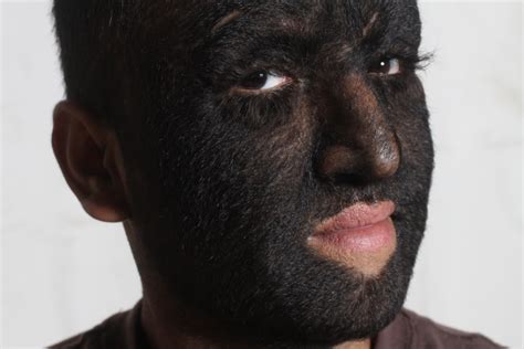 Facial Hair Growth Disease