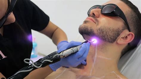 facial laser hair removal men