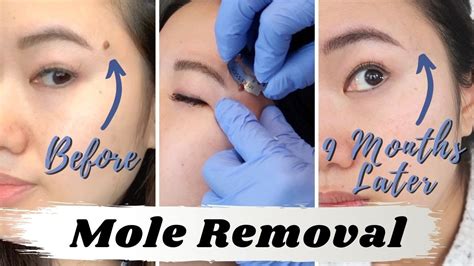 facial mole removal healing time