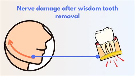 Facial Nerve Damage Wisdom Teeth