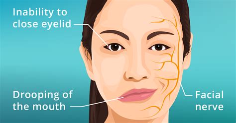 facial nerve stimulation bell's palsy