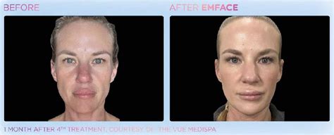 facial rejuvenation near me reviews