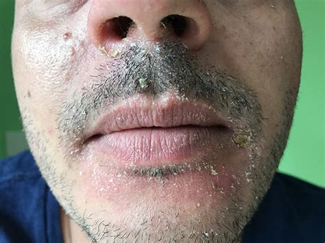 facial seborrheic dermatitis skincare