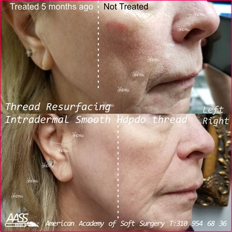 Facial Threading Recovery