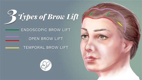 Factors Influencing Eyebrow Lift Cost