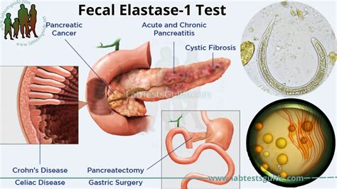 Faecal Elastase High