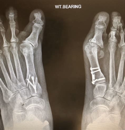 failed bunion surgery pictures